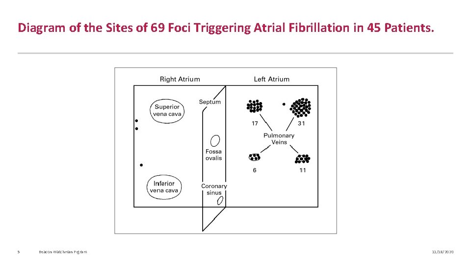 Diagram of the Sites of 69 Foci Triggering Atrial Fibrillation in 45 Patients. 5