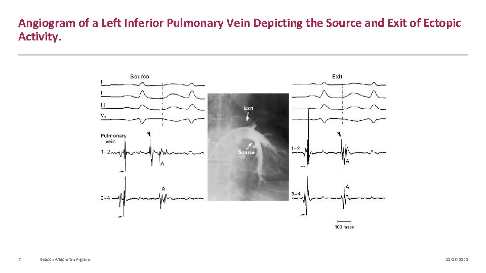 Angiogram of a Left Inferior Pulmonary Vein Depicting the Source and Exit of Ectopic
