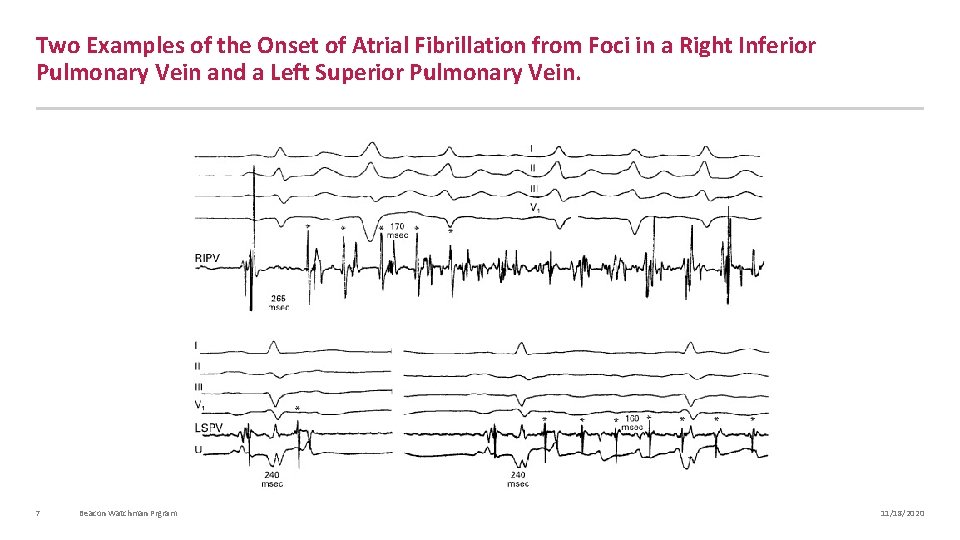 Two Examples of the Onset of Atrial Fibrillation from Foci in a Right Inferior