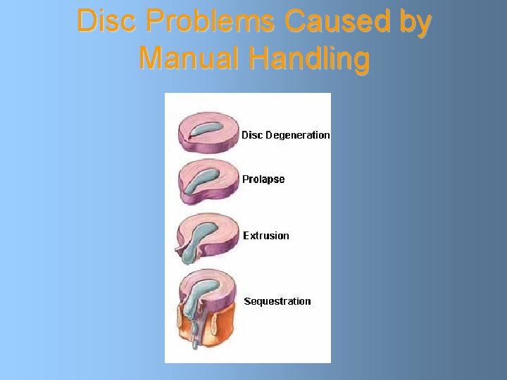 Disc Problems Caused by Manual Handling 