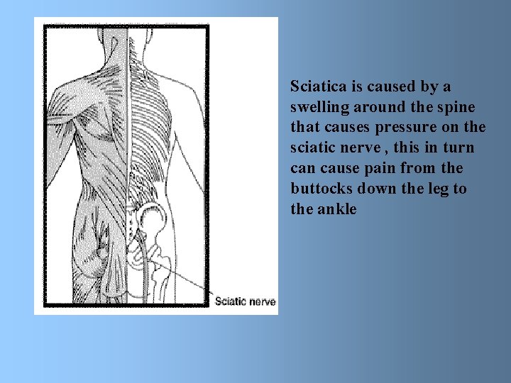 Sciatica is caused by a swelling around the spine that causes pressure on the