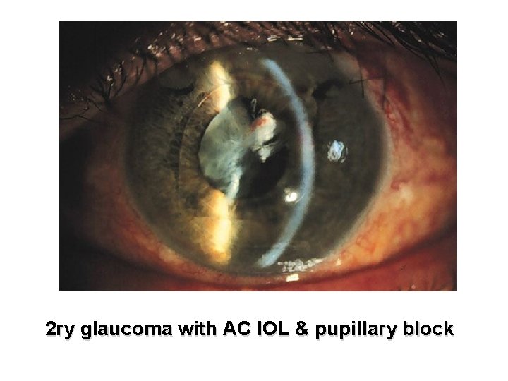 2 ry glaucoma with AC IOL & pupillary block 