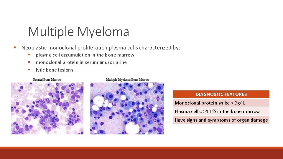 Multiple Myeloma § Neoplastic monoclonal proliferation plasma cells characterized by: § § § plasma