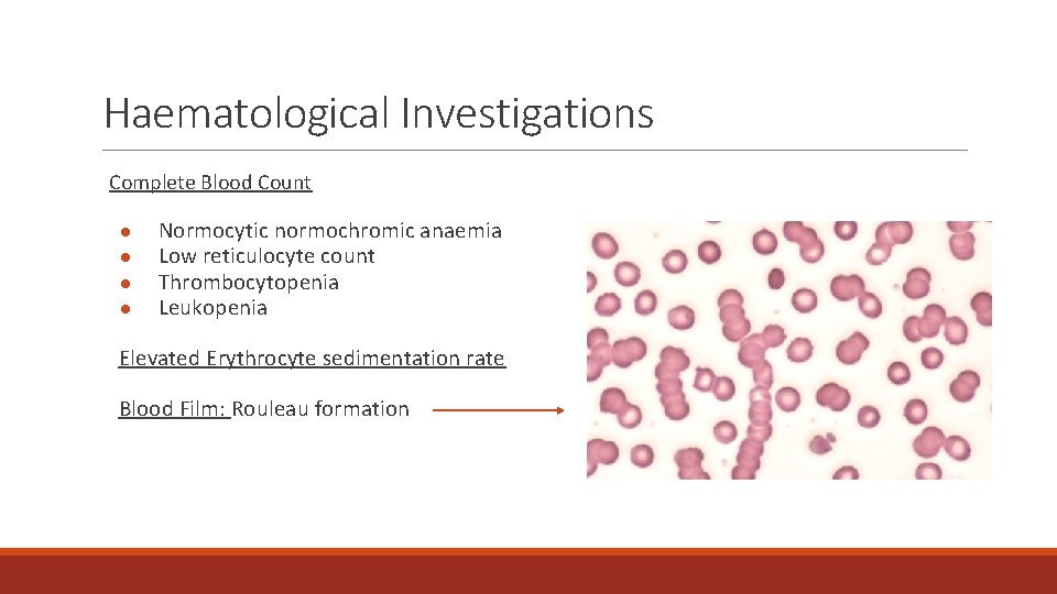 Haematological Investigations Complete Blood Count ● ● Normocytic normochromic anaemia Low reticulocyte count Thrombocytopenia