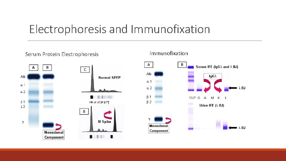 Electrophoresis and Immunofixation Serum Protein Electrophoresis Immunofixation 