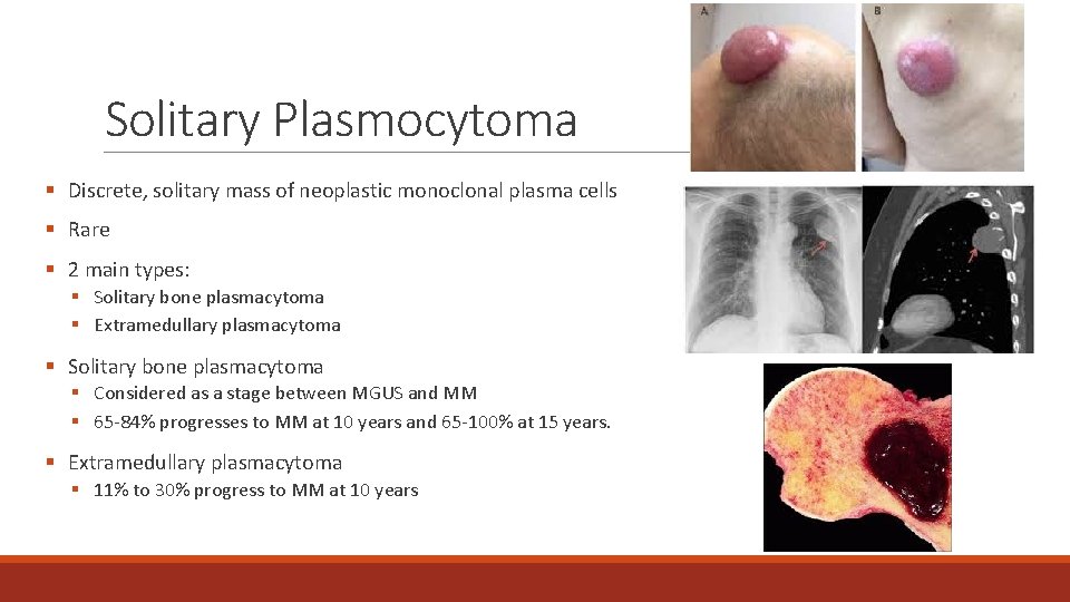 Solitary Plasmocytoma § Discrete, solitary mass of neoplastic monoclonal plasma cells § Rare §