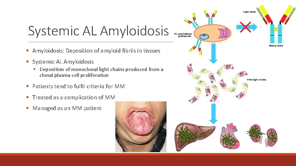 Systemic AL Amyloidosis § Amyloidosis: Deposition of amyloid fibrils in tissues § Systemic AL