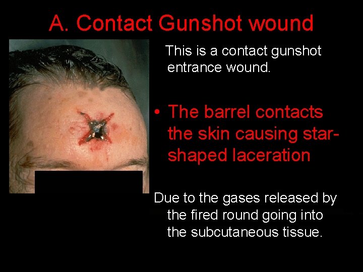 A. Contact Gunshot wound This is a contact gunshot entrance wound. • The barrel