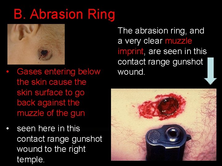 B. Abrasion Ring • Gases entering below the skin cause the skin surface to