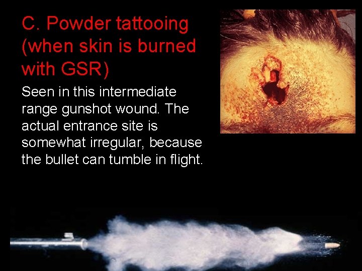 C. Powder tattooing (when skin is burned with GSR) Seen in this intermediate range