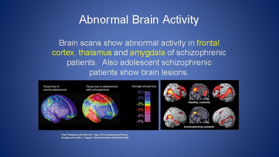 Abnormal Brain Activity Brain scans show abnormal activity in frontal cortex, thalamus and amygdala