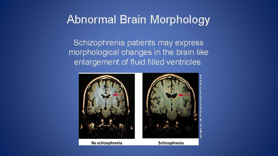 Abnormal Brain Morphology Schizophrenia patients may express morphological changes in the brain like enlargement