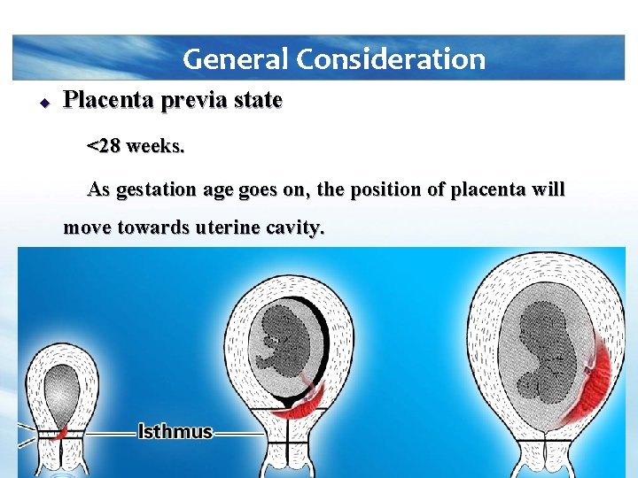 General Consideration u Placenta previa state <28 weeks. As gestation age goes on, the