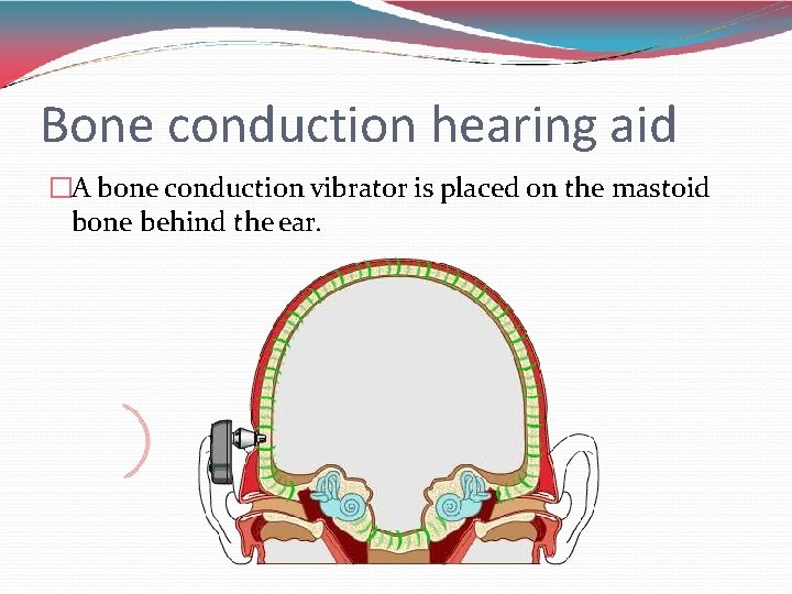 Bone conduction hearing aid �A bone conduction vibrator is placed on the mastoid bone