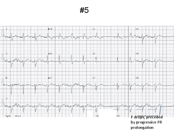#5 P drops, preceded by progressive PR prolongation 