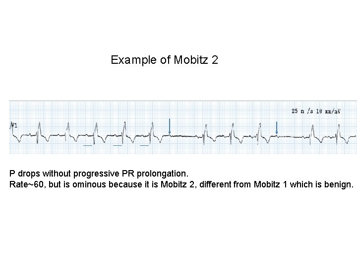 Example of Mobitz 2 P drops without progressive PR prolongation. Rate~60, but is ominous