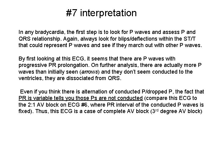 #7 interpretation In any bradycardia, the first step is to look for P waves