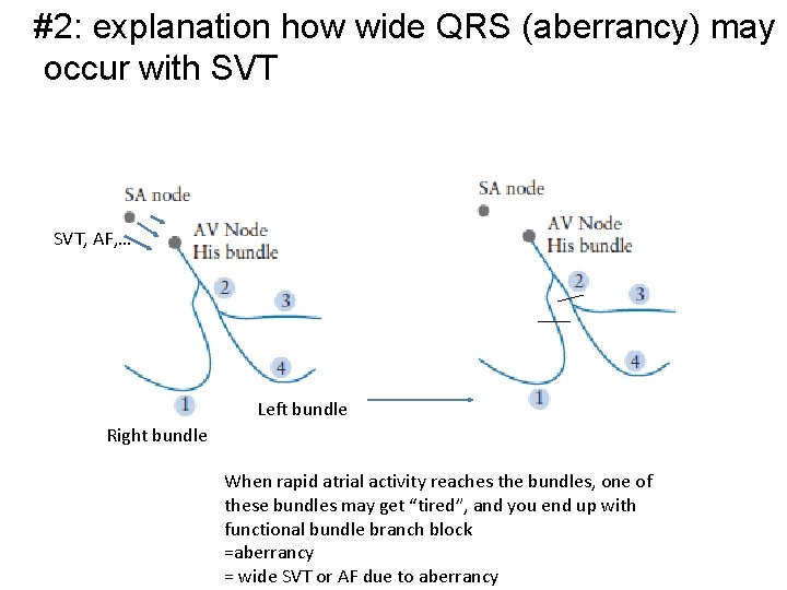 #2: explanation how wide QRS (aberrancy) may occur with SVT, AF, … Leftbundle Right