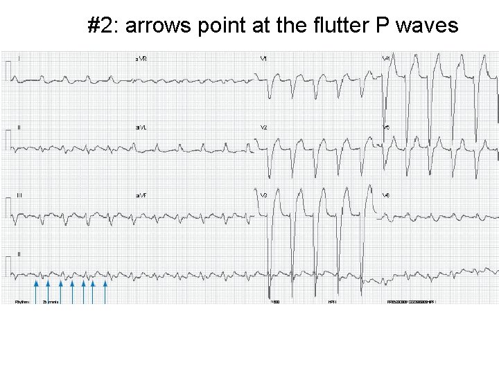 #2: arrows point at the flutter P waves 