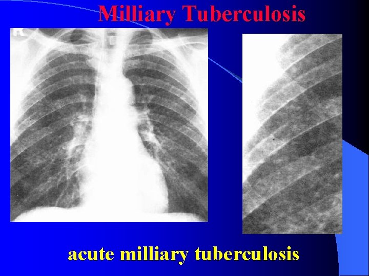 Milliary Tuberculosis acute milliary tuberculosis 