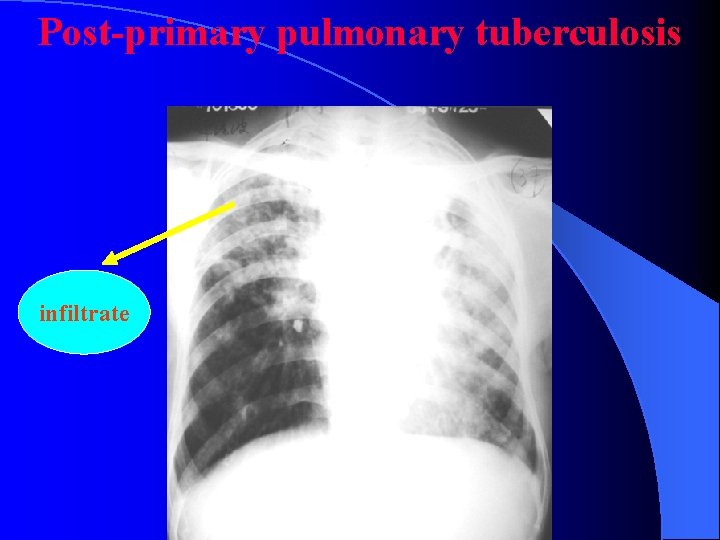 Post-primary pulmonary tuberculosis infiltrate 