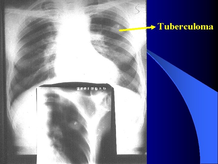 Tuberculoma 