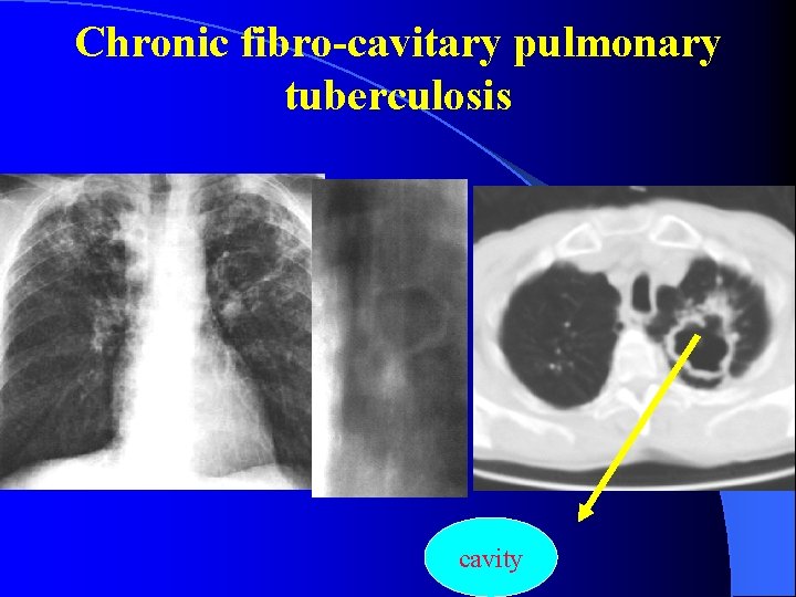 Chronic fibro-cavitary pulmonary tuberculosis cavity 