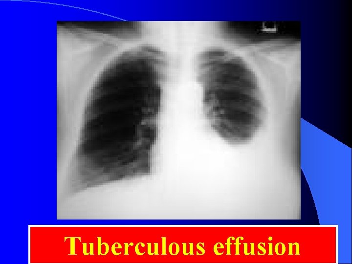 Tuberculous effusion 