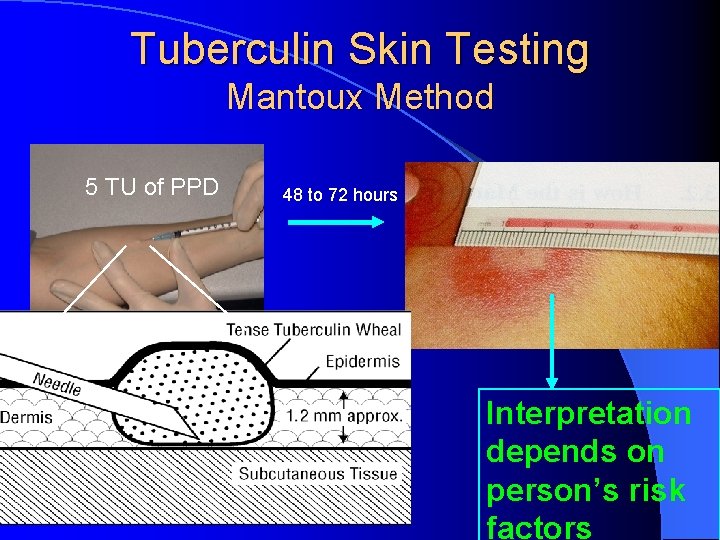 Tuberculin Skin Testing Mantoux Method 5 TU of PPD 48 to 72 hours Interpretation