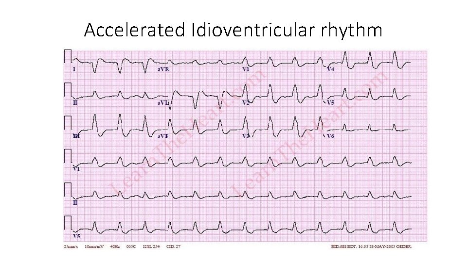 Accelerated Idioventricular rhythm 