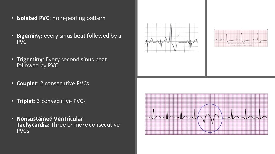  • Isolated PVC: no repeating pattern • Bigeminy: every sinus beat followed by