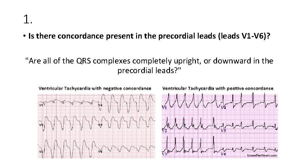 1. • Is there concordance present in the precordial leads (leads V 1 -V