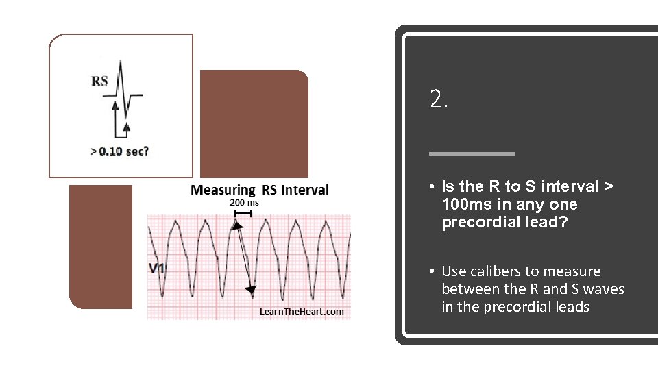 2. • Is the R to S interval > 100 ms in any one