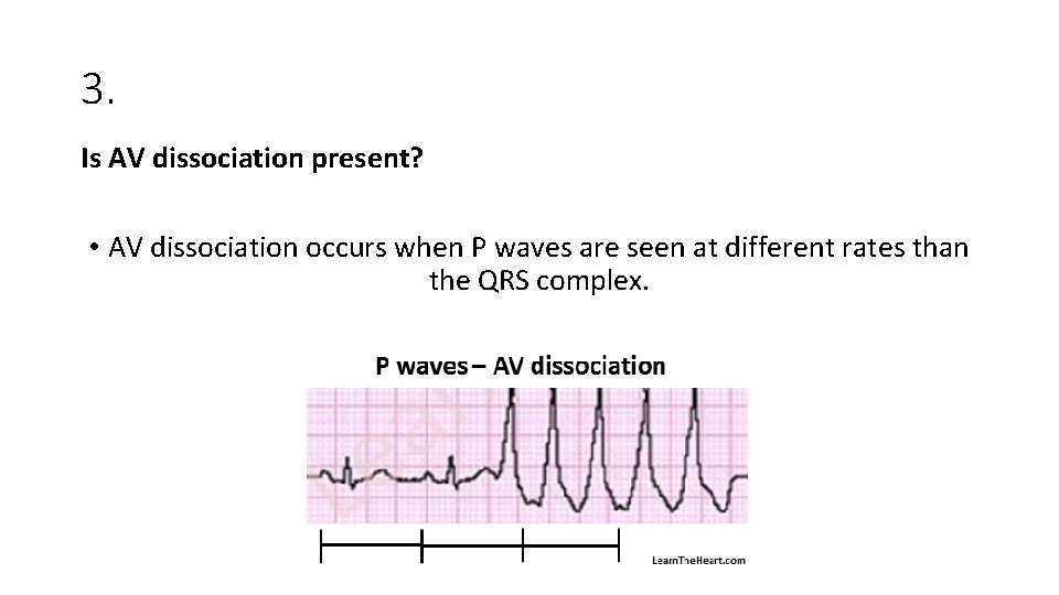 3. Is AV dissociation present? • AV dissociation occurs when P waves are seen