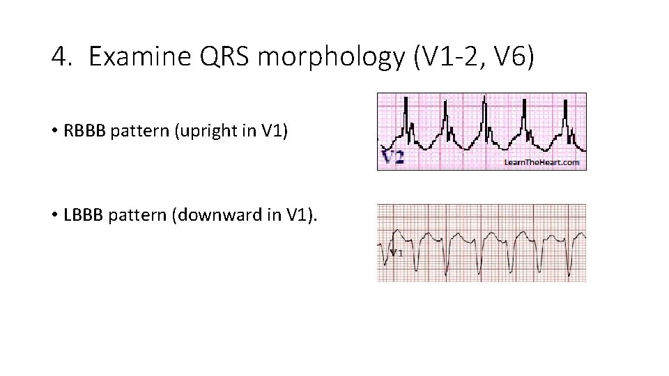 4. Examine QRS morphology (V 1 -2, V 6) • RBBB pattern (upright in