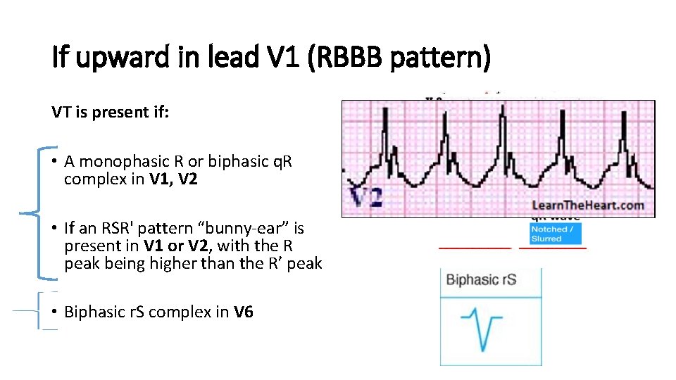 If upward in lead V 1 (RBBB pattern) VT is present if: • A