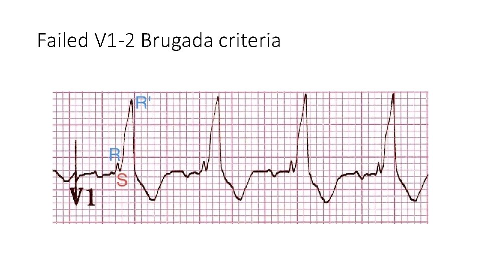 Failed V 1 -2 Brugada criteria 