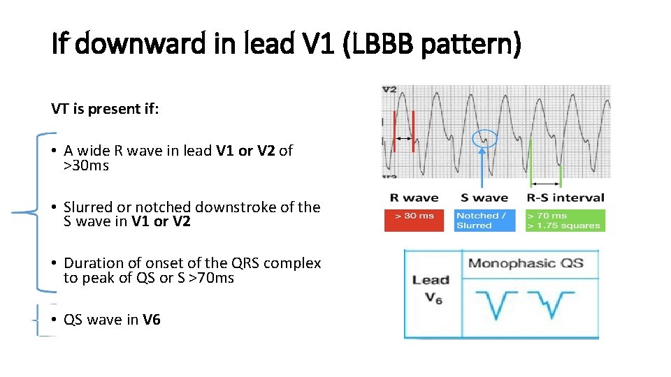 If downward in lead V 1 (LBBB pattern) VT is present if: • A