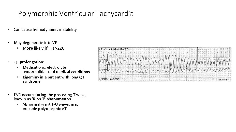 Polymorphic Ventricular Tachycardia • Can cause hemodynamic instability • May degenerate into VF •