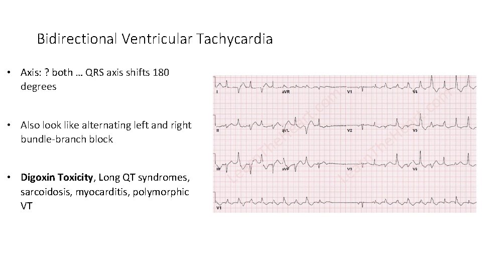 Bidirectional Ventricular Tachycardia • Axis: ? both … QRS axis shifts 180 degrees •