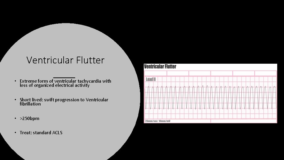 Ventricular Flutter • Extreme form of ventricular tachycardia with loss of organized electrical activity