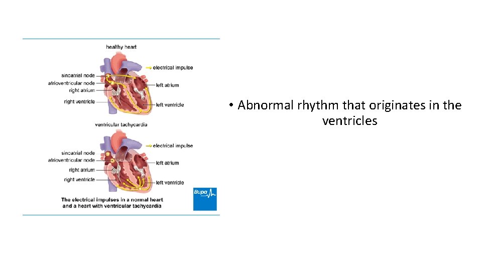  • Abnormal rhythm that originates in the ventricles 