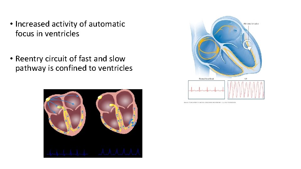  • Increased activity of automatic focus in ventricles • Reentry circuit of fast