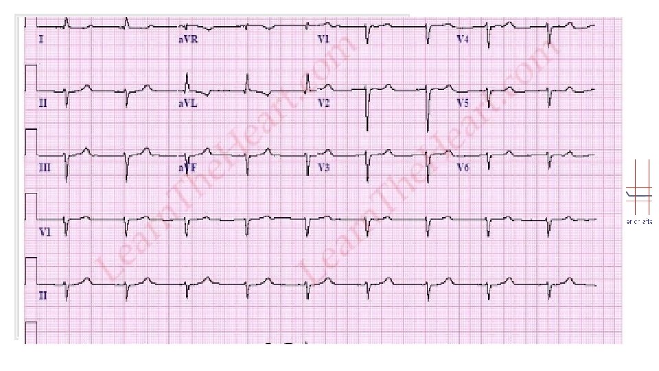 Junctional Rhythm • The electrical activation originates near or within the AV node •