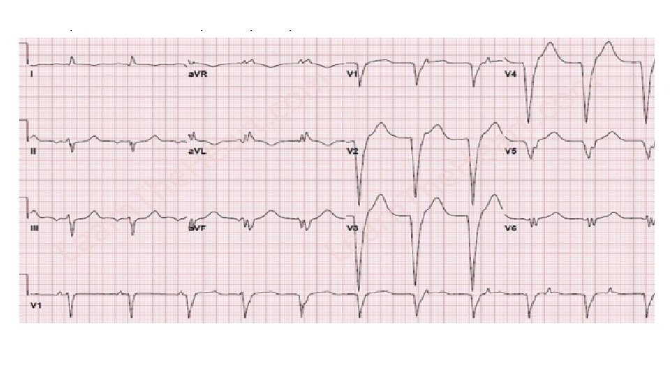 Idioventricular rhythm • Originate in the ventricles “slow VT” • All characteristics of VT