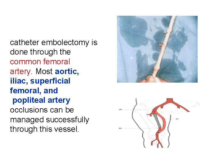 catheter embolectomy is done through the common femoral artery. Most aortic, iliac, superficial femoral,