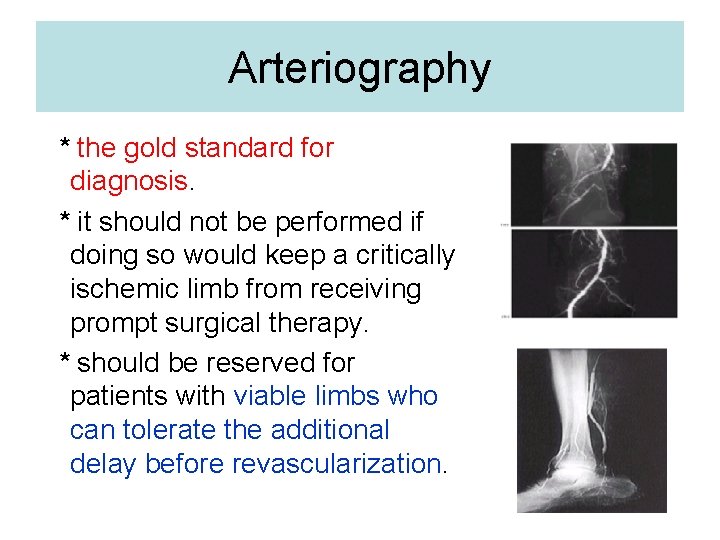Arteriography * the gold standard for diagnosis. * it should not be performed if