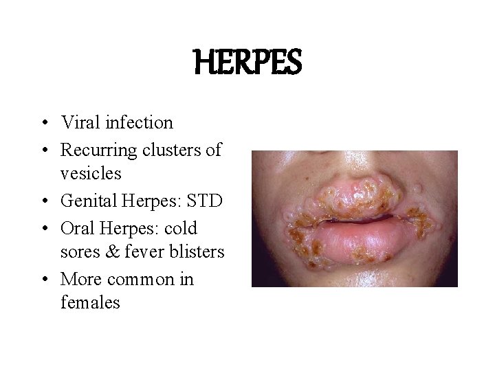 HERPES • Viral infection • Recurring clusters of vesicles • Genital Herpes: STD •