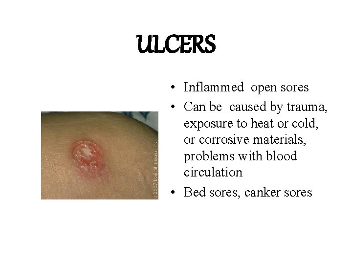 ULCERS • Inflammed open sores • Can be caused by trauma, exposure to heat