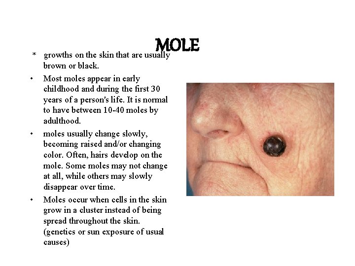 * • • • MOLE growths on the skin that are usually brown or * • • • MOLE growths on the skin that are usually brown or